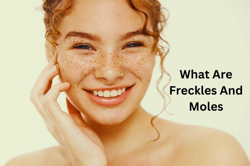 What Are Freckles And Moles